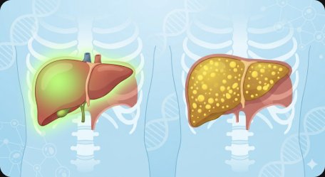 2026 지방간(MASLD) 완벽 가이드 — 원인·초기 증상·진단 검사(간수치·초음파·FIB-4)·등급별 치료법·식단·운동·간경변 예방까지 총정리